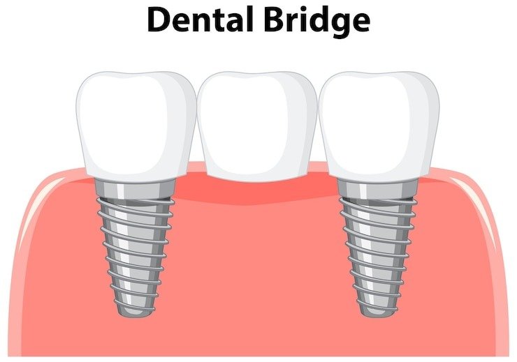 Best Teeth Crowns & Bridges Treatment in Hauz Khas