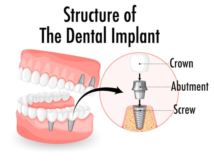 Dental Implants in New Delhi