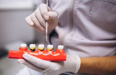 Best Crowns & Bridges Treatment in Hauz Khas