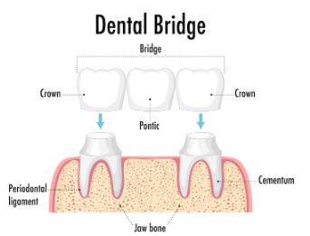 Best Painless Teeth RCT treatment in South Delhi