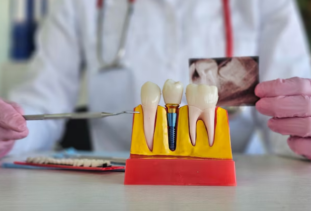 Dental Implants Clinic in Saket