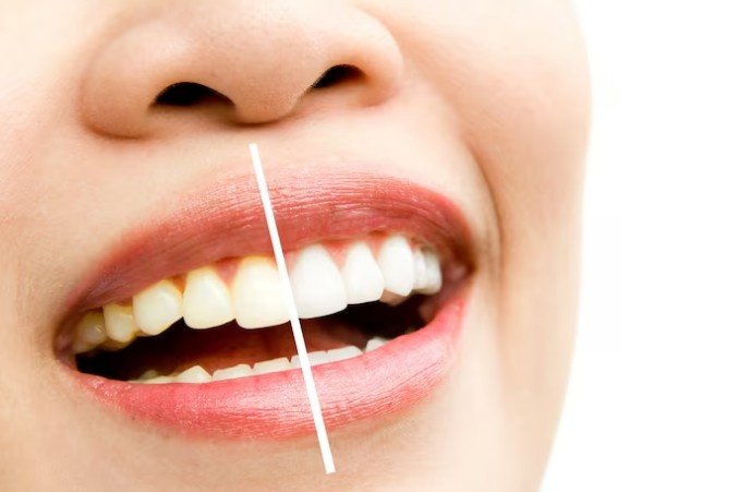 Teeth Whitening Services in Saket