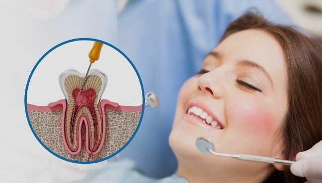 Painless Root Canal Treatment in Saket