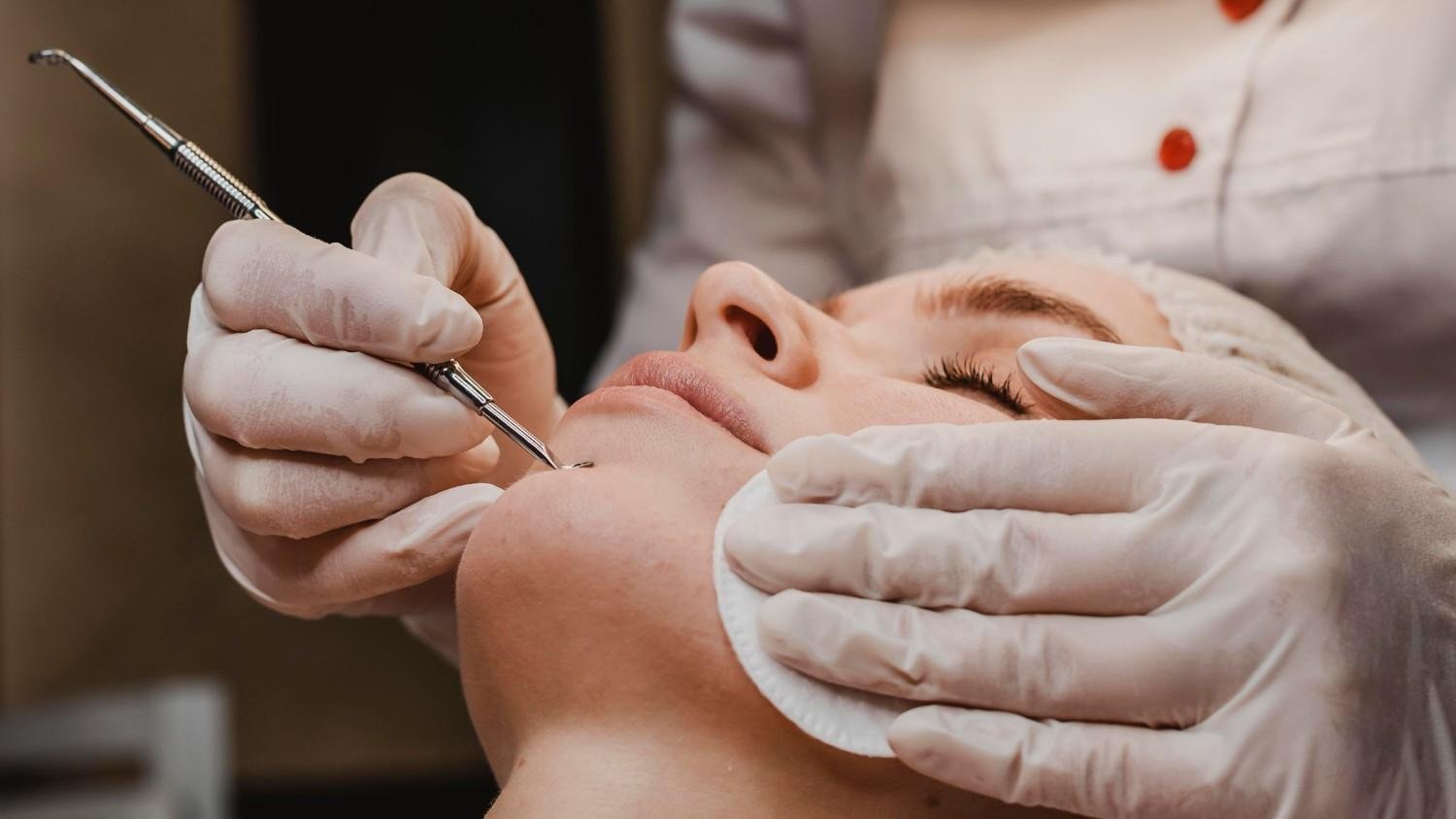 Best Acne mark removal Treatment in Delhi