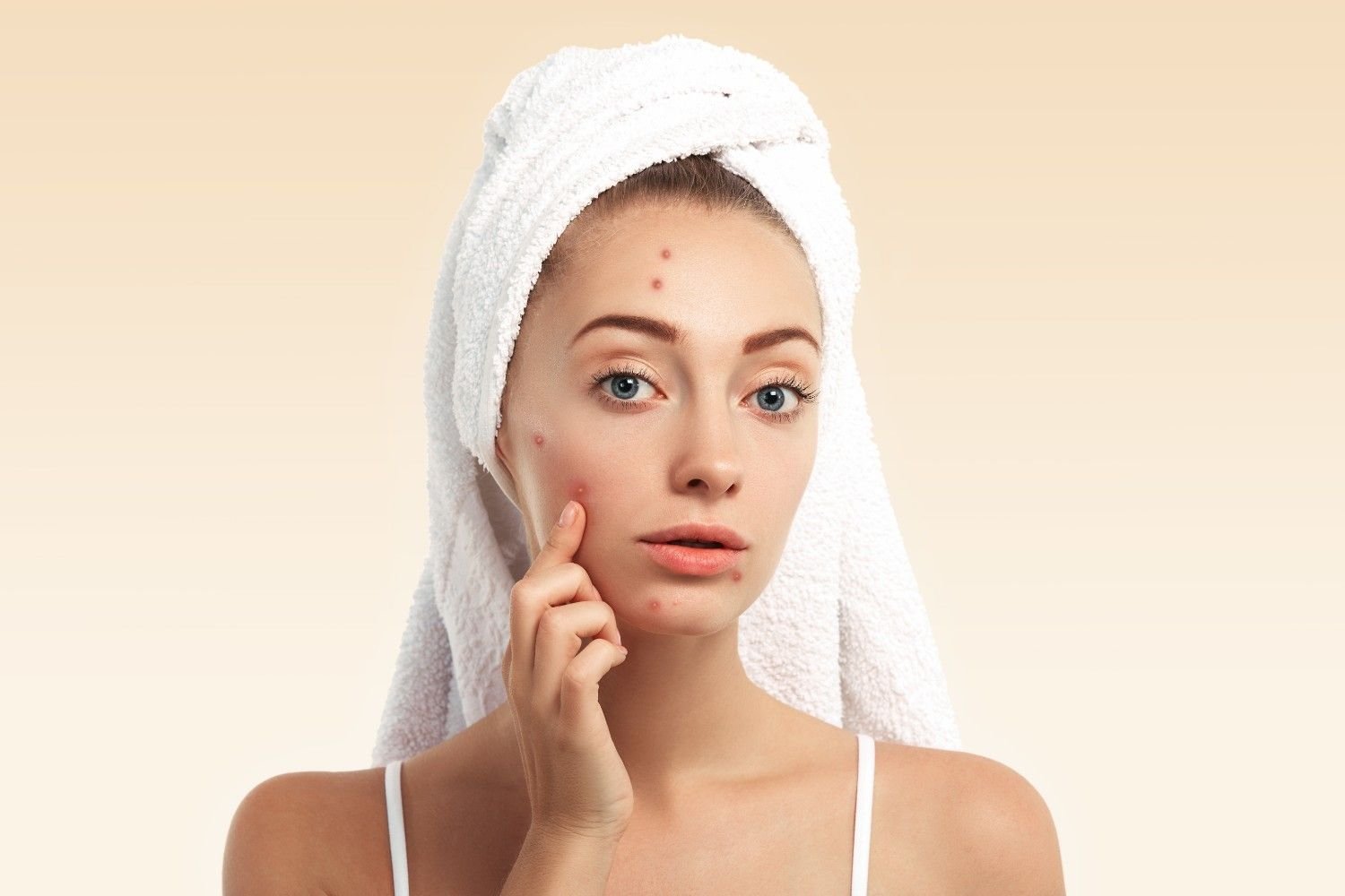 Best Acne Treatment in Saket