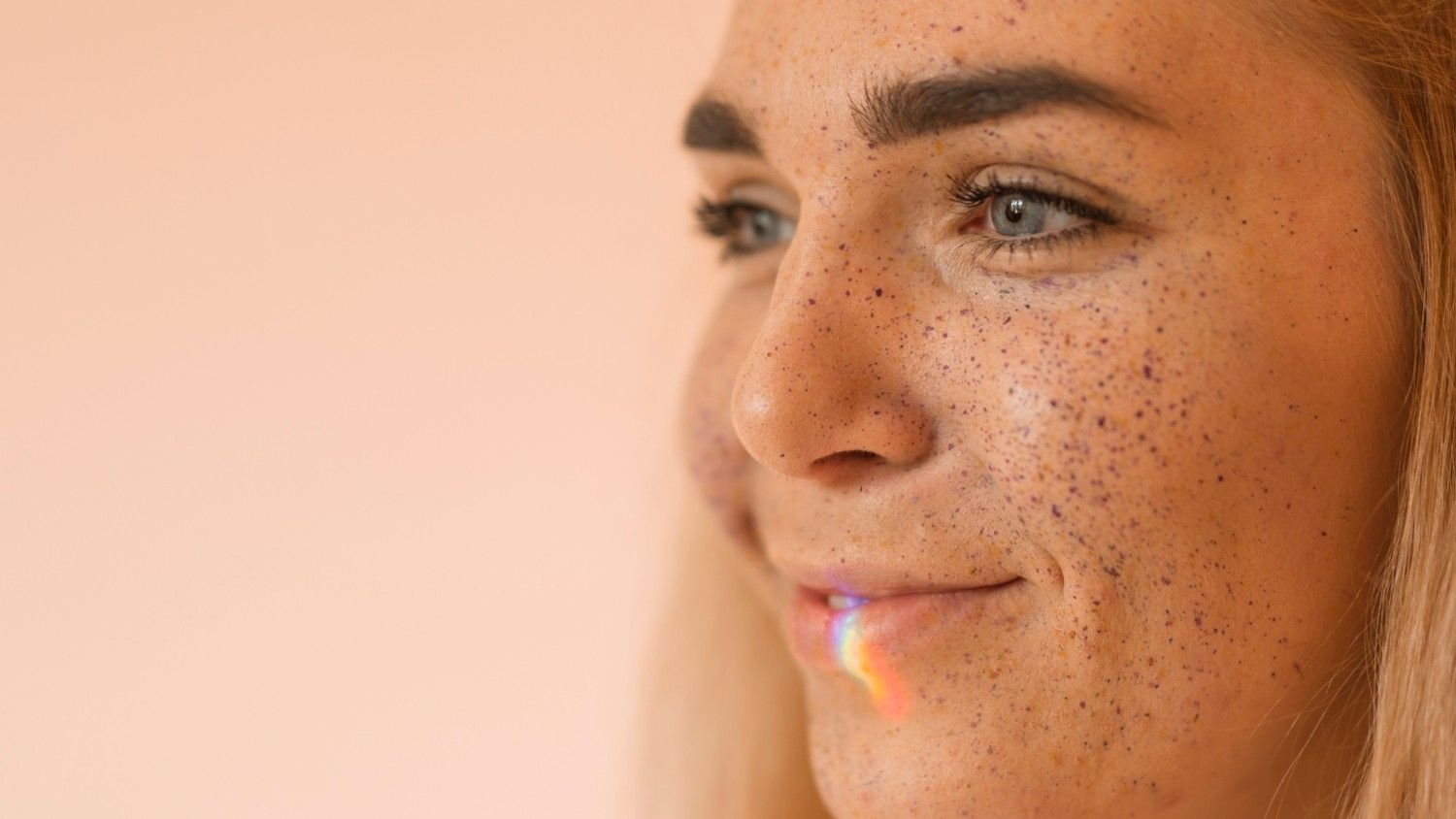 Melasma Pigmentation Specialist in saket