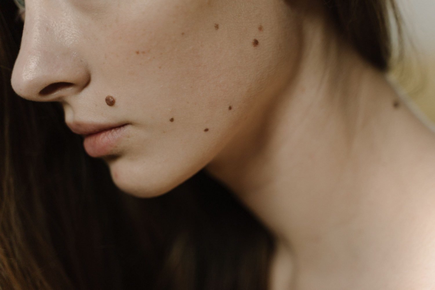 Mole Removal Treatment in Saket