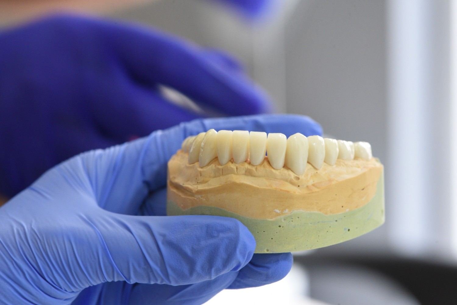 Dental Implants in Saket